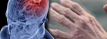 Elde titreme ve hareketlerde yavaşlama Parkinson belirtisi olabilir