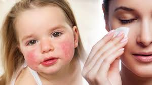 Mevsim geçişlerinde cilt kuruluğuna dikkat