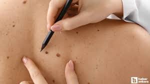 Cilt kanserine karşı 37 ilde ücretsiz deri taraması yapılacak